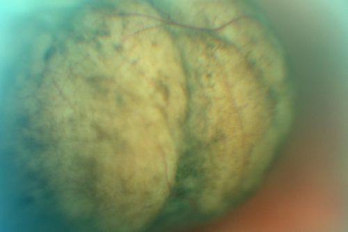 Choroidal Melanoma (Medium) Exudative Retinal Detachment 
87-year-old man noticed a new onset floater a few months ago. OD is 20/40, OS is 20/30
