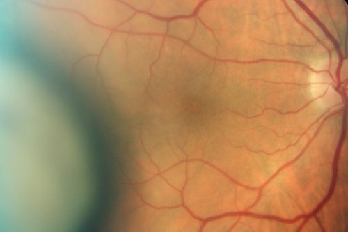 Choroidal Melanoma (Medium) Exudative Retinal Detachment 
87-year-old man noticed a new onset floater a few months ago. OD is 20/40, OS is 20/30
