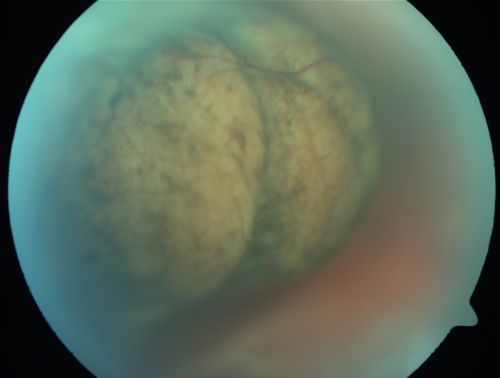 Choroidal Melanoma (Medium) Exudative Retinal Detachment 
87-year-old man noticed a new onset floater a few months ago. OD is 20/40, OS is 20/30

