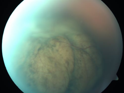 Choroidal Melanoma (Medium) Exudative Retinal Detachment 
87-year-old man noticed a new onset floater a few months ago. OD is 20/40, OS is 20/30
