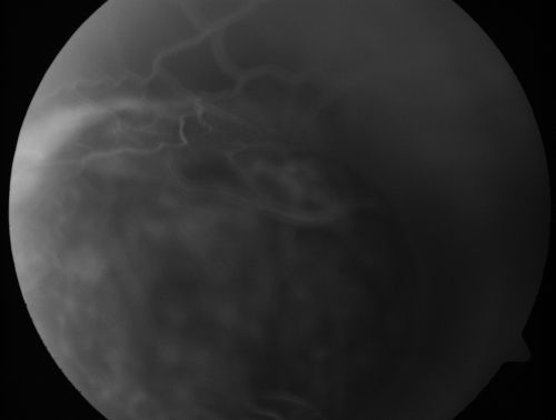 Choroidal Melanoma (Medium) Exudative Retinal Detachment 
87-year-old man noticed a new onset floater a few months ago. OD is 20/40, OS is 20/30

