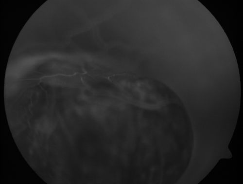 Choroidal Melanoma (Medium) Exudative Retinal Detachment 
87-year-old man noticed a new onset floater a few months ago. OD is 20/40, OS is 20/30
