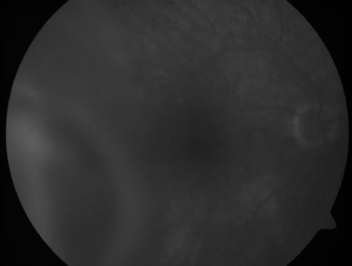 Choroidal Melanoma (Medium) Exudative Retinal Detachment 
87-year-old man noticed a new onset floater a few months ago. OD is 20/40, OS is 20/30
