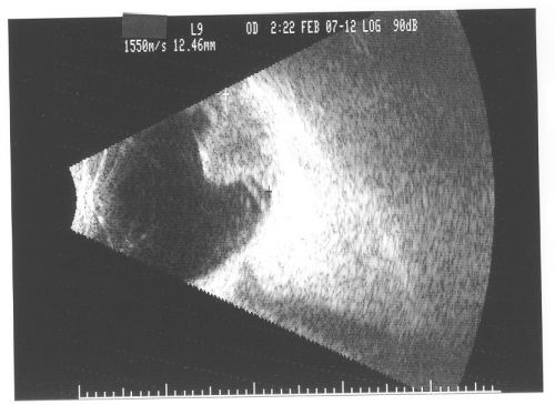 Choroidal Melanoma (Medium) Exudative Retinal Detachment 
87-year-old man noticed a new onset floater a few months ago. OD is 20/40, OS is 20/30
