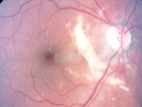 Choroidal Rupture - 13 year old - 3 months following injury to eye with aluminum foil ball corneal laceration 
13-year-old 3 months post injury to right eye with corneal laceration and cryo to a retinal tear on July 27th and then six clock hours away laser to a retinal tear on October 20th.  His vision is a little better in the eye.

VISUAL ACUITY:  Vision OD is 20/120.
