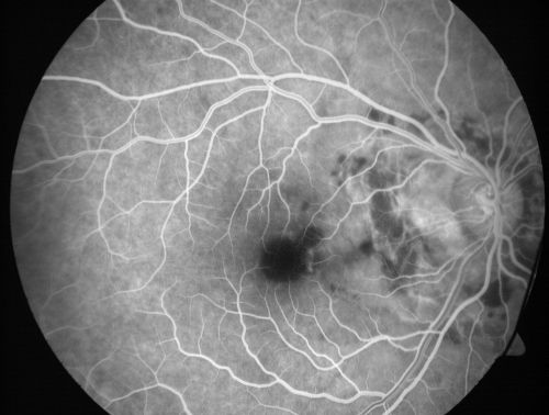 Choroidal Rupture - 13 year old - 3 months following injury to eye with aluminum foil ball corneal laceration 
13-year-old 3 months post injury to right eye with corneal laceration and cryo to a retinal tear on July 27th and then six clock hours away laser to a retinal tear on October 20th.  His vision is a little better in the eye.

VISUAL ACUITY:  Vision OD is 20/120.
