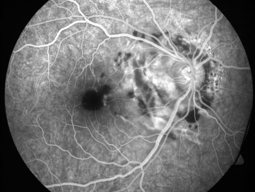 Choroidal Rupture - 13 year old - 3 months following injury to eye with aluminum foil ball corneal laceration 
13-year-old 3 months post injury to right eye with corneal laceration and cryo to a retinal tear on July 27th and then six clock hours away laser to a retinal tear on October 20th.  His vision is a little better in the eye.

VISUAL ACUITY:  Vision OD is 20/120.
