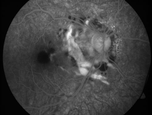 Choroidal Rupture - 13 year old - 3 months following injury to eye with aluminum foil ball corneal laceration 
13-year-old 3 months post injury to right eye with corneal laceration and cryo to a retinal tear on July 27th and then six clock hours away laser to a retinal tear on October 20th.  His vision is a little better in the eye.

VISUAL ACUITY:  Vision OD is 20/120.
