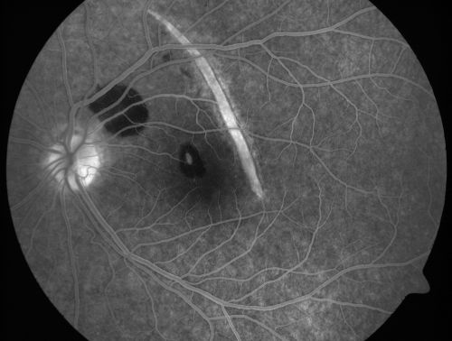 Choroidal Rupture and small Hemorrhage - Assault
34 year old man. The patient reports he was assaulted by a couple of adolescents near downtown St. Petersburg about forty-eight hours ago.   He reports the pain in the left eye has significantly improved, but his vision is a little fuzzy and he sees some floaters in the left eye.  20/125 OD, 20/20 OS.  Pinhole improves in the right eye to 20/50.  IOP:  15 OD, 13 OS.
SLIT LAMP EXAMINATION:  Biomicroscopy reveals 3+ pupillary reaction OD, 2+ OS with no afferent pupillary defect.  EXTENDED OPHTHALMOSCOPY:  Extended funduscopy with Volk 90-diopter lens and fundus drawings of both eyes reveal a clear view with no posterior vitreous separation.  C/D ratio is 0.2.  There is no vitreous debris or hemorrhage.  Large retinal vessels and macula are healthy.  The retinal periphery, inspected with scleral depression for 360Â° shows no retinal tears, breaks, or detachments.

Keywords: choroidal rupture;scar;hemorrhage;trauma