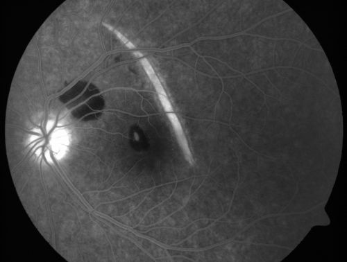 Choroidal Rupture and small Hemorrhage - Assault
34 year old man. The patient reports he was assaulted by a couple of adolescents near downtown St. Petersburg about forty-eight hours ago.   He reports the pain in the left eye has significantly improved, but his vision is a little fuzzy and he sees some floaters in the left eye.  20/125 OD, 20/20 OS.  Pinhole improves in the right eye to 20/50.  IOP:  15 OD, 13 OS.
SLIT LAMP EXAMINATION:  Biomicroscopy reveals 3+ pupillary reaction OD, 2+ OS with no afferent pupillary defect.  EXTENDED OPHTHALMOSCOPY:  Extended funduscopy with Volk 90-diopter lens and fundus drawings of both eyes reveal a clear view with no posterior vitreous separation.  C/D ratio is 0.2.  There is no vitreous debris or hemorrhage.  Large retinal vessels and macula are healthy.  The retinal periphery, inspected with scleral depression for 360Â° shows no retinal tears, breaks, or detachments.

Keywords: choroidal rupture;scar;hemorrhage;trauma