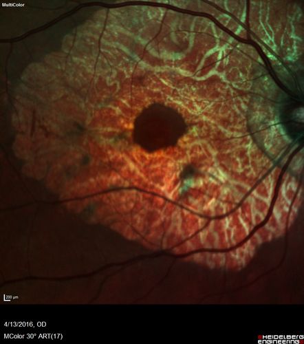Central Areolar Choroidal Dystrophy
Vision loss from early 60's.  This 78 year old woman has choroidal atrophy centrally.
