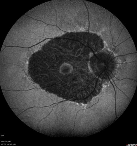 Central Areolar Choroidal Dystrophy
Vision loss from early 60's.  This 78 year old woman has choroidal atrophy centrally.

