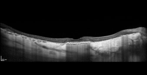 Central Areolar Choroidal Dystrophy
Vision loss from early 60's.  This 78 year old woman has choroidal atrophy centrally.
