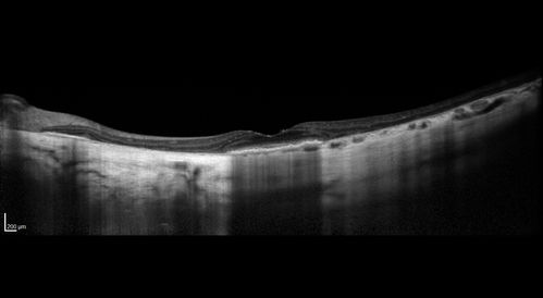 Central Areolar Choroidal Dystrophy
Vision loss from early 60's.  This 78 year old woman has choroidal atrophy centrally.

