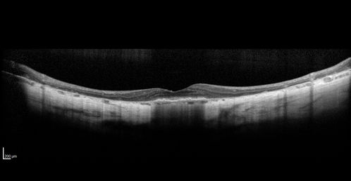 Central Areolar Choroidal Dystrophy
Vision loss from early 60's.  This 78 year old woman has choroidal atrophy centrally.
