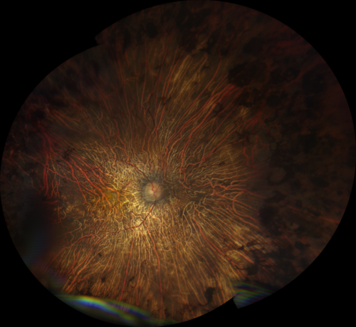 Choroideremia - Adult
69 year old man with no family history of choroideremia and gradual vision loss in both eyes.  VVA 20/125 OD; 20/63 OS
