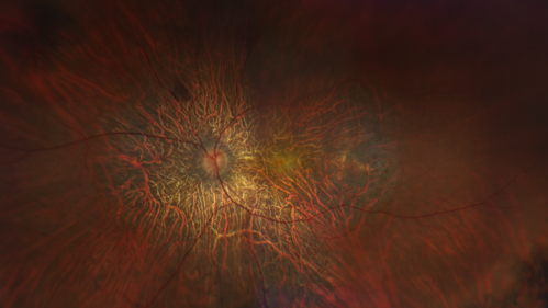 Choroideremia - Adult
69 year old man with no family history of choroideremia and gradual vision loss in both eyes.  VVA 20/125 OD; 20/63 OS
