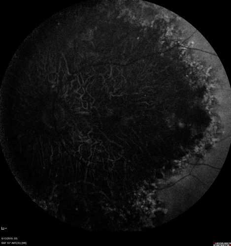 Choroideremia - Adult
69 year old man with no family history of choroideremia and gradual vision loss in both eyes.  VVA 20/125 OD; 20/63 OS
