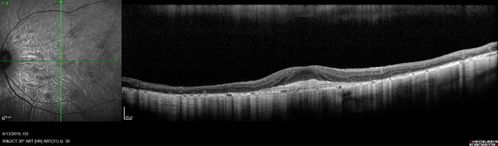 Choroideremia - Adult
69 year old man with no family history of choroideremia and gradual vision loss in both eyes.  VVA 20/125 OD; 20/63 OS
