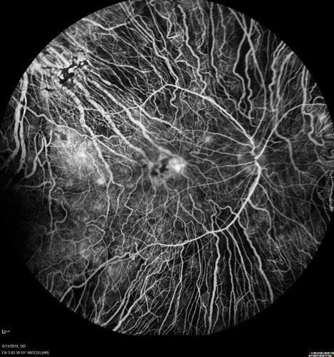 Choroideremia - Adult
69 year old man with no family history of choroideremia and gradual vision loss in both eyes.  VVA 20/125 OD; 20/63 OS
