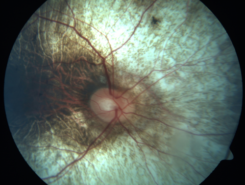 Choroideremia - Complete CHM gene deletion
Vision loss since age 20 - now age 36 VA 20/160 (about) OU
