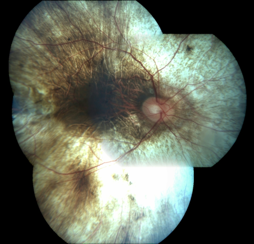 Choroideremia - Complete CHM gene deletion
Vision loss since age 20 - now age 36 VA 20/160 (about) OU
