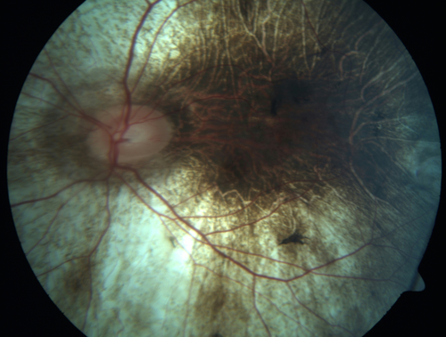 Choroideremia - Complete CHM gene deletion
Vision loss since age 20 - now age 36 VA 20/160 (about) OU

