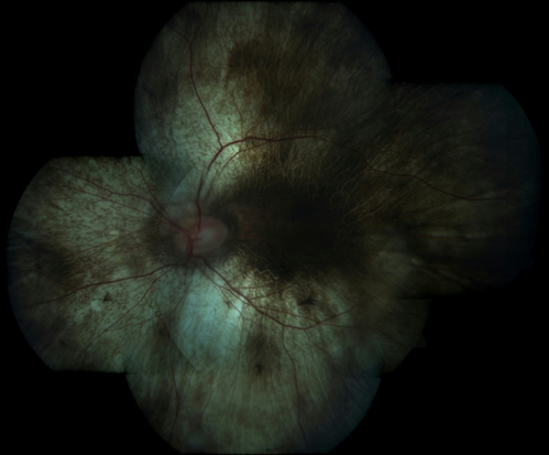 Choroideremia - Complete CHM gene deletion
Vision loss since age 20 - now age 36 VA 20/160 (about) OU
