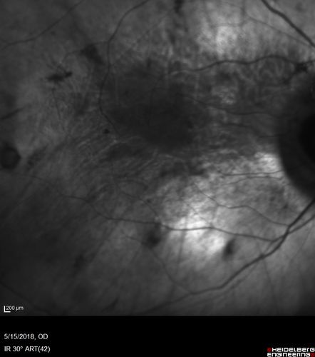 Choroideremia - Complete CHM gene deletion
Vision loss since age 20 - now age 36 VA 20/160 (about) OU
