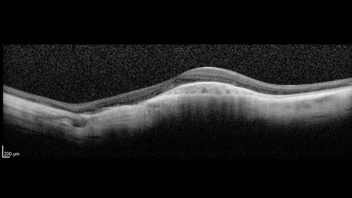 Choroideremia - Complete CHM gene deletion
Vision loss since age 20 - now age 36 VA 20/160 (about) OU
