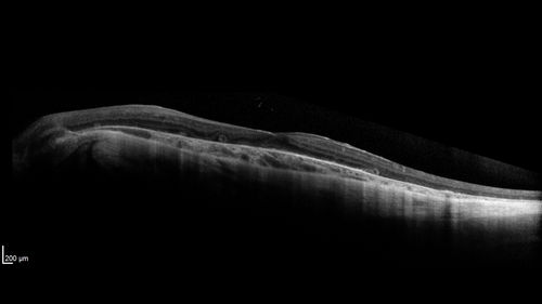 Choroideremia - Complete CHM gene deletion
Vision loss since age 20 - now age 36 VA 20/160 (about) OU
