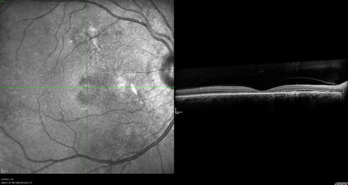 Chronic Central Serous Chorioretinopathy Both Eyes
60 year old man with 20 year history of chronic CSR. He has had laser and PDT in the past.  The left eye has been 20/100 for decades.  The right eye is now declining.  Was 20/32 and is down to 20/50.  There is chronic low grade subretinal fluid away from the center in the right eye.  (focal laser in the right eye in 2005, left eye 2001 at BPEI).  Refampin tried in 2012, Aldactone in 2013.  PDT in 204 and 2017  Images are from 2017
