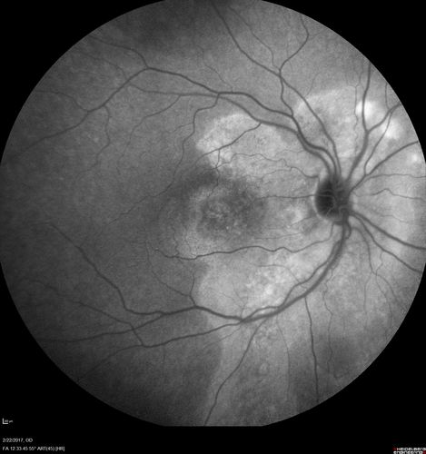 Chronic Central Serous Chorioretinopathy Both Eyes
60 year old man with 20 year history of chronic CSR. He has had laser and PDT in the past.  The left eye has been 20/100 for decades.  The right eye is now declining.  Was 20/32 and is down to 20/50.  There is chronic low grade subretinal fluid away from the center in the right eye.  (focal laser in the right eye in 2005, left eye 2001 at BPEI).  Refampin tried in 2012, Aldactone in 2013.  PDT in 204 and 2017  Images are from 2017
