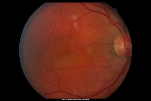 Chronic Central Serous Chorioretinopathy Both Eyes
60 year old man with 20 year history of chronic CSR. He has had laser and PDT in the past.  The left eye has been 20/100 for decades.  The right eye is now declining.  Was 20/32 and is down to 20/50.  There is chronic low grade subretinal fluid away from the center in the right eye.  (focal laser in the right eye in 2005, left eye 2001 at BPEI).  Refampin tried in 2012, Aldactone in 2013.  PDT in 204 and 2017  Images are from 2017
