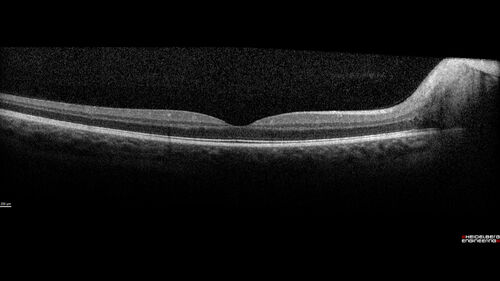 Congenital Hydrocephalus - 21 year old - Papilledema
21 year old man The patient had a v-p shunt removed in January 2017.  He has not had escalating headaches.  The shunt was put in in 2015.  He was born with hydrocephalus.  The shunt was possibly overdraining for 5 years so there were problems with slipped ventricles and low CSR pressure.  The pressure was checked today and it was perfect.  There is still a bulb so the CSF pressure can be checked.  There was eye examination in November showing possible papilledema.  
VA OD: sc20/40+2 NscJ5
VA OS: sc20/32+2 NscJ1
