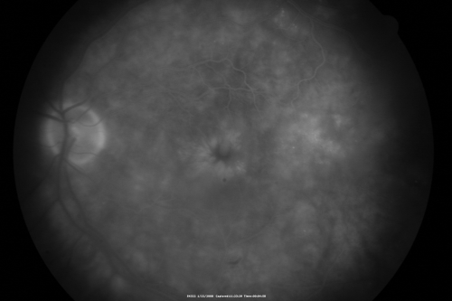 Chronic Pseudophakic Cystoid Macular Edema in a Patient with Diabetes
74-year-old woman has chronic cystoid macular edema in the left eye.  She has had vision loss intermittently in that eye for 2 years, the right eye, unfortunately, lost vision from a central retinal vein occlusion in 6 years ago.
