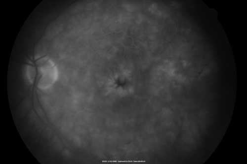 Chronic Pseudophakic Cystoid Macular Edema in a Patient with Diabetes
74-year-old woman has chronic cystoid macular edema in the left eye.  She has had vision loss intermittently in that eye for 2 years, the right eye, unfortunately, lost vision from a central retinal vein occlusion in 6 years ago.
