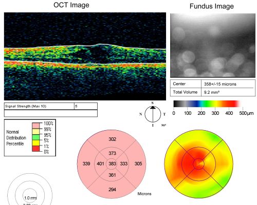 Chronic Pseudophakic Cystoid Macular Edema in a Patient with Diabetes
74-year-old woman has chronic cystoid macular edema in the left eye.  She has had vision loss intermittently in that eye for 2 years, the right eye, unfortunately, lost vision from a central retinal vein occlusion in 6 years ago.
