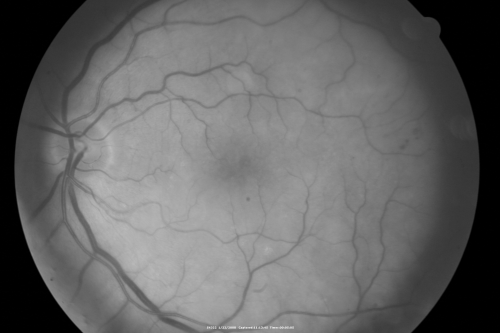 Chronic Pseudophakic Cystoid Macular Edema in a Patient with Diabetes
74-year-old woman has chronic cystoid macular edema in the left eye.  She has had vision loss intermittently in that eye for 2 years, the right eye, unfortunately, lost vision from a central retinal vein occlusion in 6 years ago.
