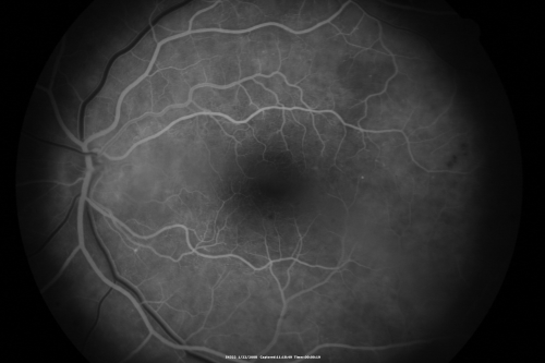 Chronic Pseudophakic Cystoid Macular Edema in a Patient with Diabetes
74-year-old woman has chronic cystoid macular edema in the left eye.  She has had vision loss intermittently in that eye for 2 years, the right eye, unfortunately, lost vision from a central retinal vein occlusion in 6 years ago.
