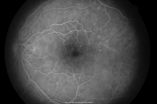 Chronic Pseudophakic Cystoid Macular Edema in a Patient with Diabetes
74-year-old woman has chronic cystoid macular edema in the left eye.  She has had vision loss intermittently in that eye for 2 years, the right eye, unfortunately, lost vision from a central retinal vein occlusion in 6 years ago.
