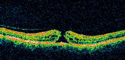 Macular Hole Closed with Vitrectomy - Preop
Keywords: macular hole; closed; vitrectomy