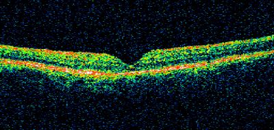 Macular Hole Closed with Vitrectomy - Post-op 20/60 Vision
Keywords: macular hole; closed; vitrectomy