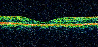 Macular Hole Closed with Vitrectomy - Post-op 20/60 Vision
Keywords: macular hole; closed; vitrectomy