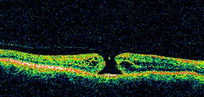 Macular Hole Closed with Vitrectomy - Preop
Keywords: macular hole; closed; vitrectomy