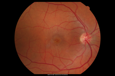 Macular Hole Closed with Vitrectomy - Preop
Keywords: macular hole; closed; vitrectomy