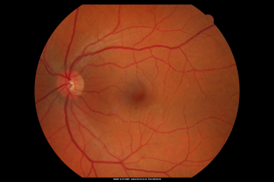 Macular Hole Closed with Vitrectomy - Preop
Keywords: macular hole; closed; vitrectomy