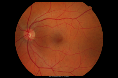 Macular Hole Closed with Vitrectomy - Preop
Keywords: macular hole; closed; vitrectomy