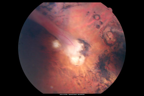 Cicatricial ROP with Macular Folds - 60 Year Old Woman Nystagmus
60-year-old  was born at 6 pounds but then she was incubated and she had difficulty with her eye subsequent to that.
VISUAL ACUITY:  OD 8/200, OS 1/200
