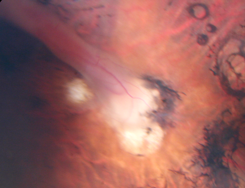 Cicatricial ROP with Macular Folds - 60 Year Old Woman Nystagmus
60-year-old  was born at 6 pounds but then she was incubated and she had difficulty with her eye subsequent to that.
VISUAL ACUITY:  OD 8/200, OS 1/200
